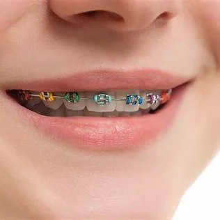 Clear aligners and braces in Udupi at Kiran Polyclinic & Dental