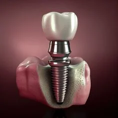 Best Dental Implants in Udupi