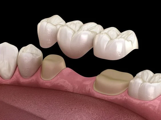 Best Dental Crowns in Udupi - Kiran Polyclinic & Dental
